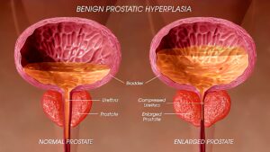 Worried about an enlarged prostate?