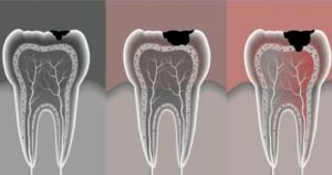 How to Restore Rotten Teeth & Gums: What Really Works (Backed by Science) 3 75250